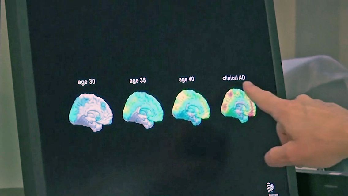 AlzheimerMedikament.jpg