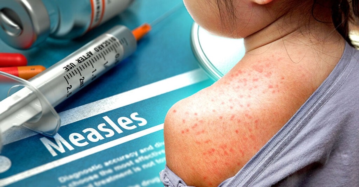 758. The measles vaccination causes measles